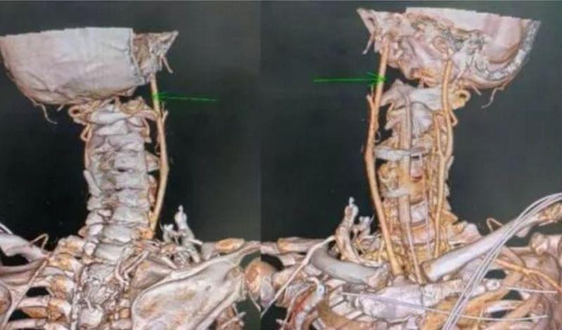 6旬男「头颈分离」 广州医院动员8科专家 奇迹出现了